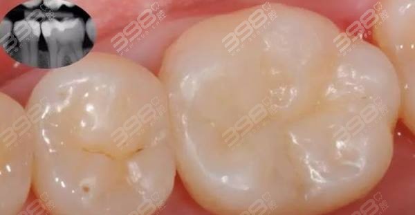 网上买的补牙洞材料怎么去除啊网上购买的补牙洞材料去除指南